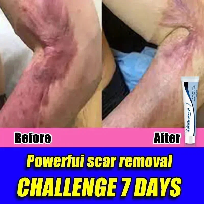 Scar Removal Cream