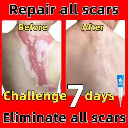 Scar Removal Cream